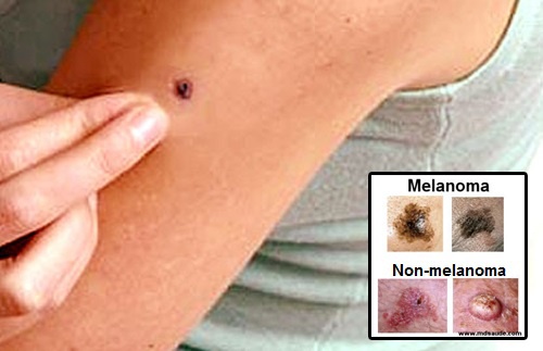 “How To Remove Your Moles, Warts & Skin Tags in 3 Days ...