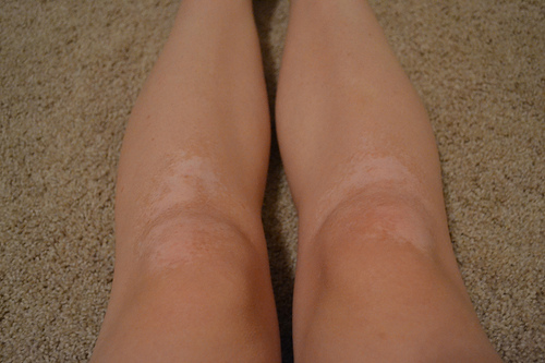 Vitiligine sulle gambe