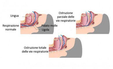 Rimedi per smettere di russare