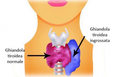 Ipertiroidismo nelle donne: sintomi e cosa mangiare