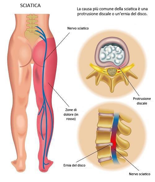 prevenzione della sciatica