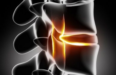 Prevenzione della sciatica: cosa c'è da sapere