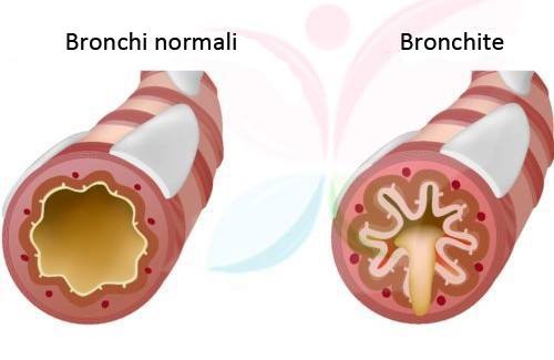 Bronchite 
