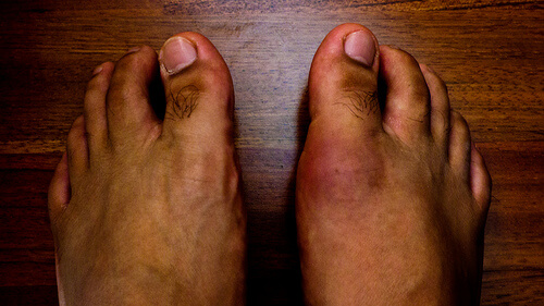 La gotta: ecco i cibi che possono provocarla