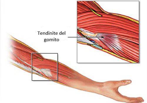 Trattare la tendinite del gomito