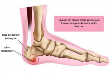 Sintomi della spina calcaneare. Come prevenirli?