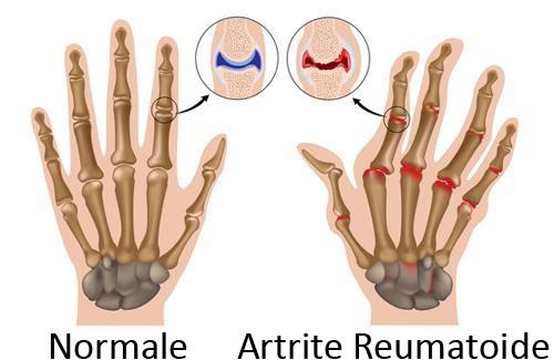 Artrite reumatoide: come tenerne sotto controllo i sintomi