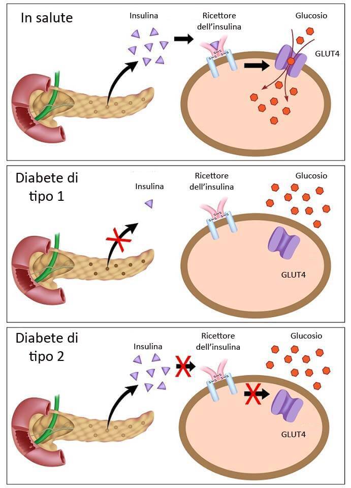 tipi diabete