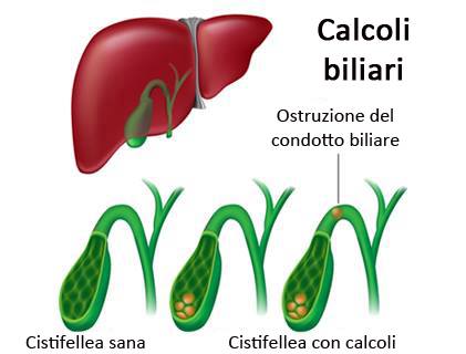Risultati immagini per cistifellea sintomi