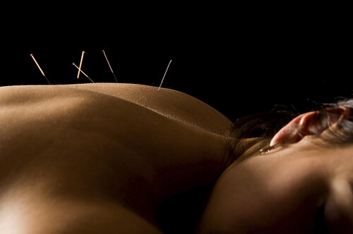 Donna sottoposta all'agopuntura