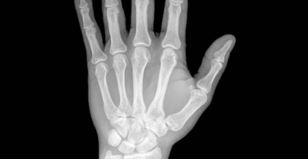 Cura per l'artrite reumatoide? Esiste o è una chimera