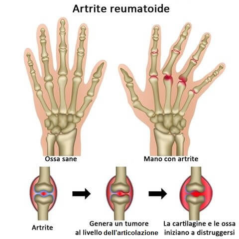 non c'è una cura per l'artrite reumatoide