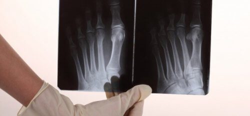 Calmare il dolore alle ossa con i rimedi naturali