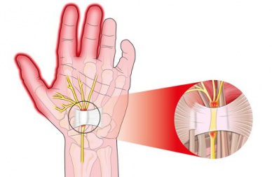 Sindrome del tunnel carpale: cause e rimedi