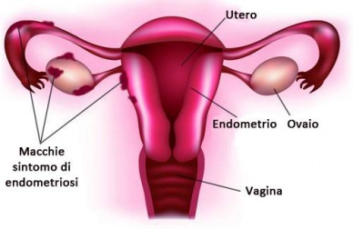 I principali sintomi dell'endometriosi