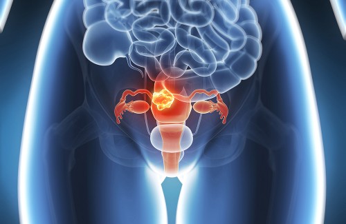 L’endometriosi: tutti i rimedi naturali