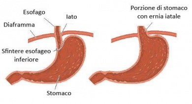 Rimedi naturali contro l'ernia iatale