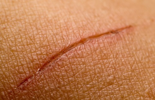 Rimedi per cicatrici