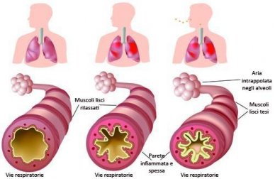 Cosa fare in caso di asma cronica e allergie?