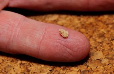 Rimedi fatti in casa per i calcoli renali