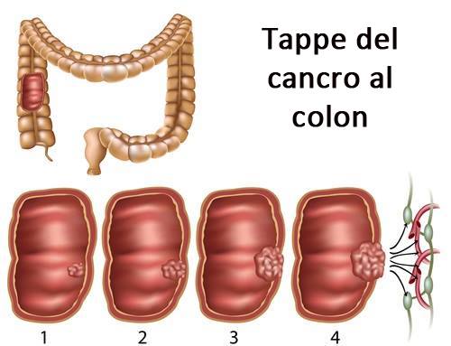 Fasi del cancro al colon