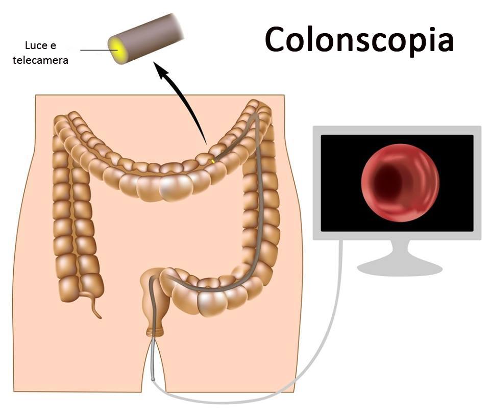 colonscopia per prevenzione malattie del colon