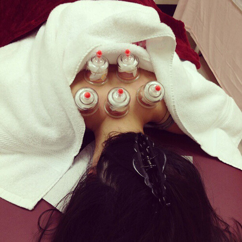 Terapia delle ventose