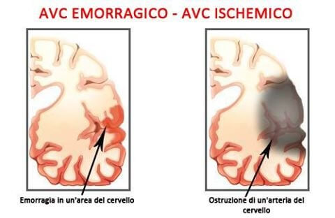 Sintomi dell'accidente cerebrovascolare o ictus