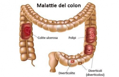 Malattie del colon: come prevenirle