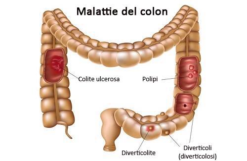 malattie colon