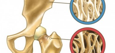 Osteoporosi e prevenzione: i metodi naturali