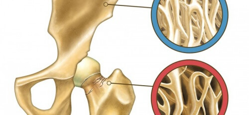 Prevenire l'osteoporosi in maniera naturale