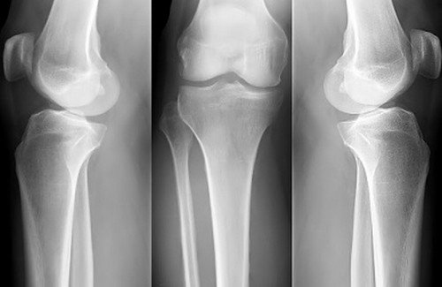 Rimedi casalinghi per l'osteoporosi