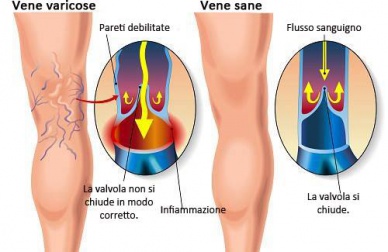 Prevenire le vene varicose, ecco come fare