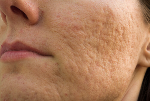 Cicatrici dell'acne