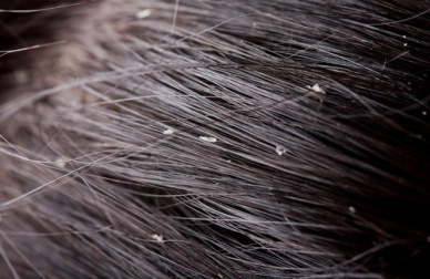 Rimedi fai da te contro la forfora