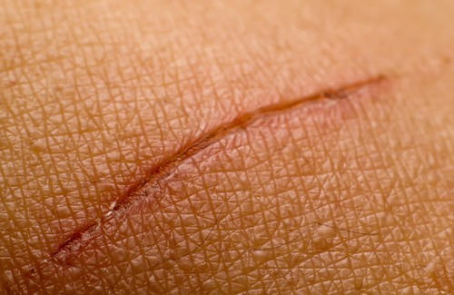 Attenuare le cicatrici o eliminarle: come fare?