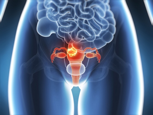 Endometriosi: la malattia che aumenta il rischio di infarto