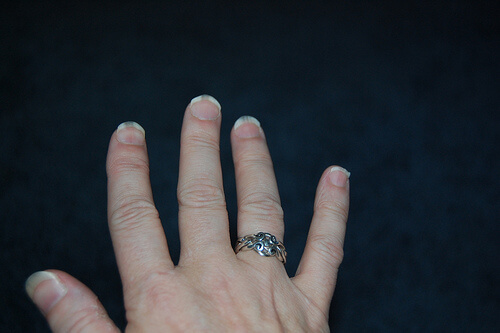 micosi delle unghie della mano