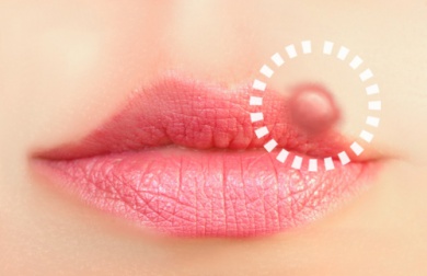 Herpes labiale simplex: rimedi naturali per combatterlo