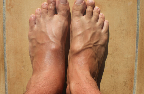 Come ridurre il gonfiore alle caviglie?