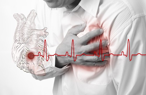 Cause e sintomi di un infarto