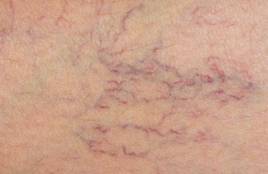 Vene varicose da giovani: cosa fare?