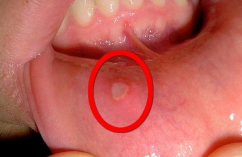 Curare le afte con rimedi naturali.