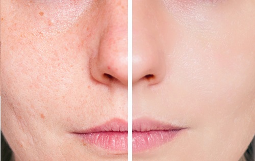 Rimedi naturali per le cicatrici dell'acne