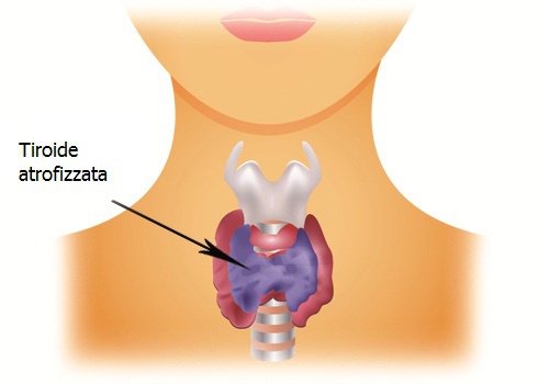 Problemi di ipotiroidismo