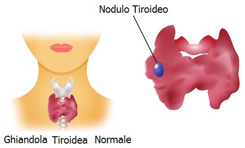 Nodulo tiroideo