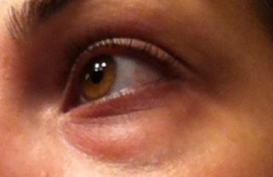 Nascondere le occhiaie e prevenirle in modo naturale