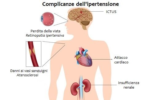 L'ipertensione arteriosa