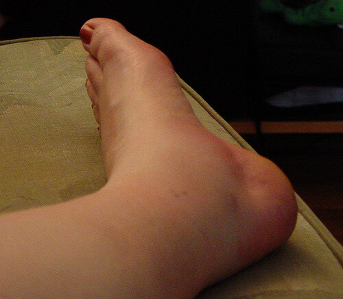 caviglia e piede confio